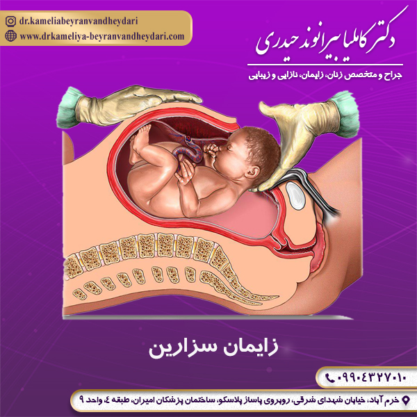 زایمان سزارین - دکتر بیرانوند