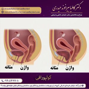 کولپورافی