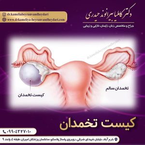 کیست تخمدان - دکتر بیراندوند