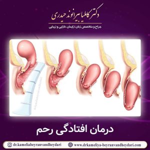 درمان افتادگی رحم