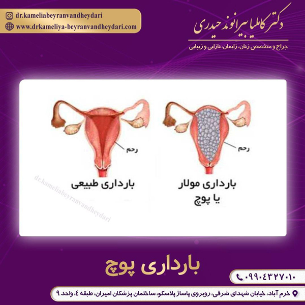 عکس بارداری پوچ - دکتر بیرانوند