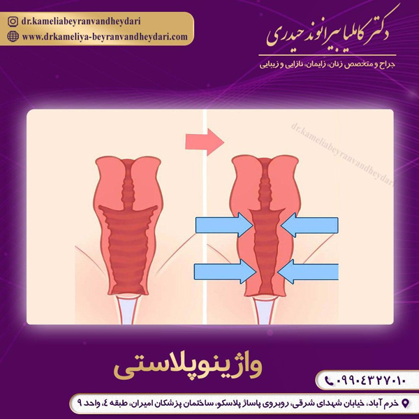 واژینوپلاستی - دکتر بیرانوند