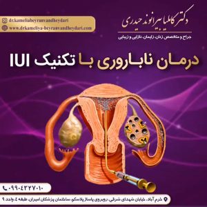درمان ناباروری با iui - دکتر بیرانوند
