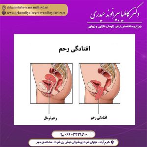 درمان افتادگی رحم