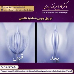 تزریق چربی به ناحیه تناسلی - دکتر بیرانوند