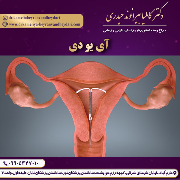 عکس آی یو دی - دکتر کاملیا بیرانوند