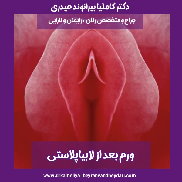 ورم بعد از لابیاپلاستی